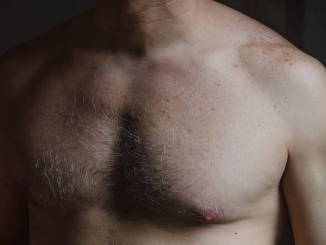 Los hombres también pueden padecer cáncer de mama: ¿Cómo detectarlo?