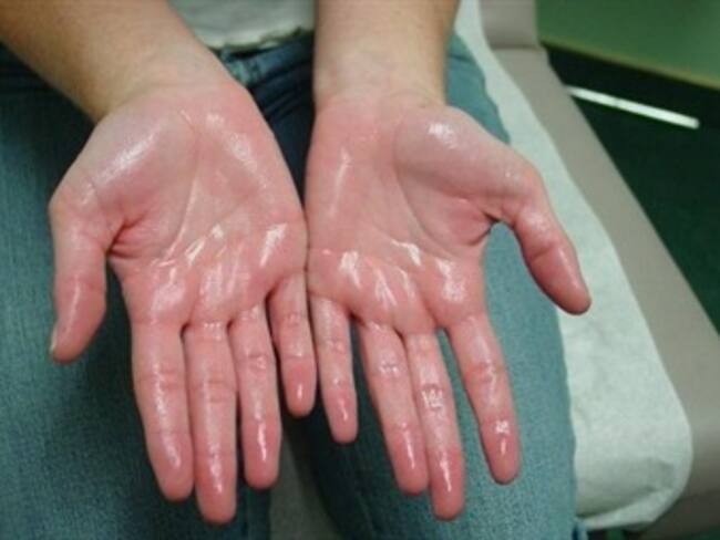 Sudor en las manos. Arieh Goldberg, médico. 03/02/13