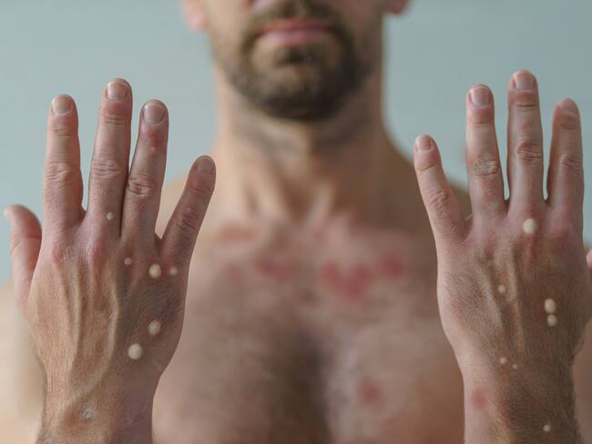 Confirman dos casos de Mpox en Sonora