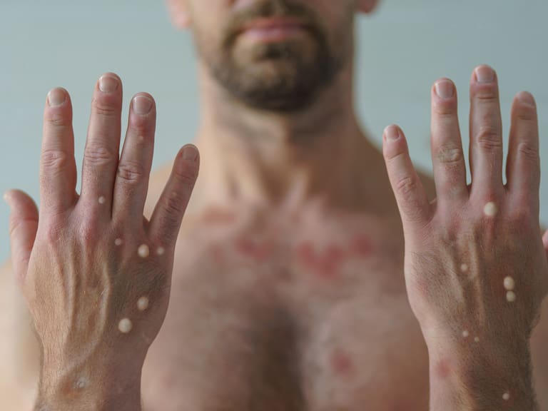 Confirman dos casos de Mpox en Sonora