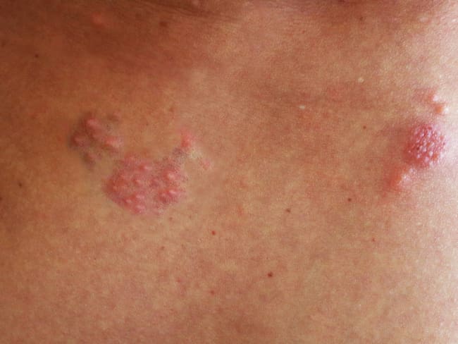 Herpes zóster, padecimiento frecuente en personas mayores de 60 años