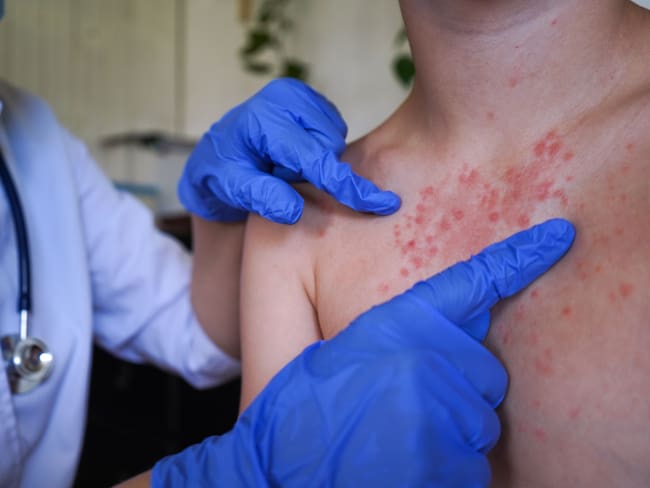 “No hay vacunas”: Xavier Tello alerta por la peor crisis de sarampión en México en 30 años