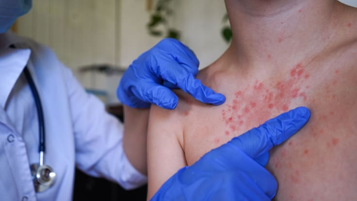 Sarampión en México: se registran 195 nuevos contagios, a un ritmo de 8 contagios por hora