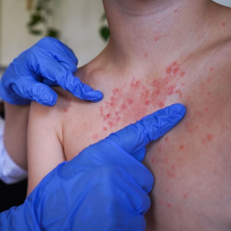 Sarampión en México: se registran 195 nuevos contagios, a un ritmo de 8 contagios por hora