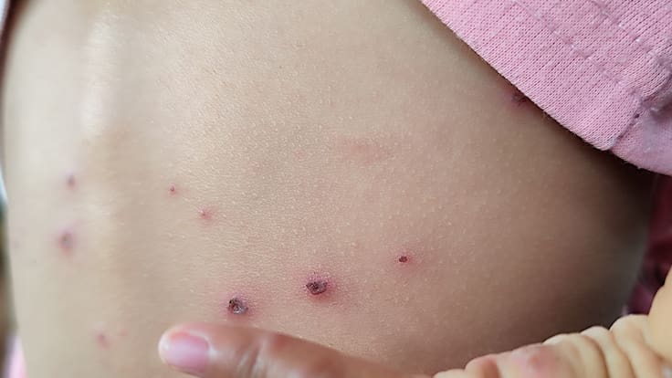 México suma 153 nuevos casos de sarampión en 24 horas; acumula 11 mil 419 contagios