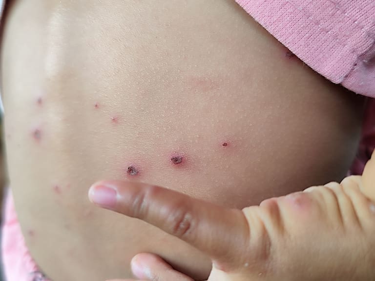 México registró en las últimas 24 horas 153 nuevos casos confirmados de sarampión, para contabilizar un acumulado de 11 mil 419 contagios