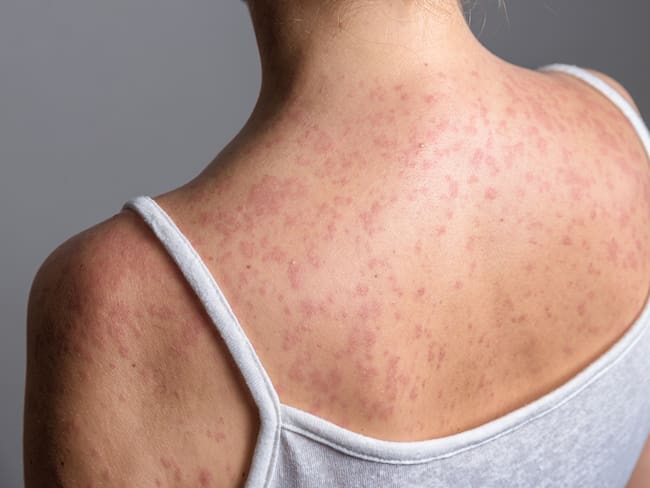 Sarampión México suma más de 15 mil casos y continúa con presencia en todo el país