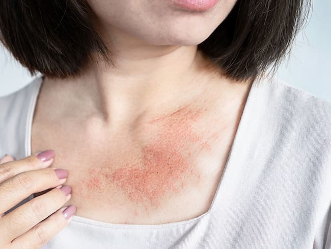 ¿Qué es la urticaria y cuándo es peligrosa? El ABC con el Dr. Carlos León