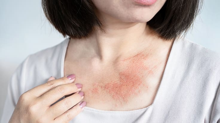 ¿Qué es la urticaria y cuándo es peligrosa? El ABC con el Dr. Carlos León