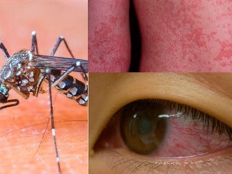 Síntomas y tratamiento: ¿Qué es el virus del Zika?