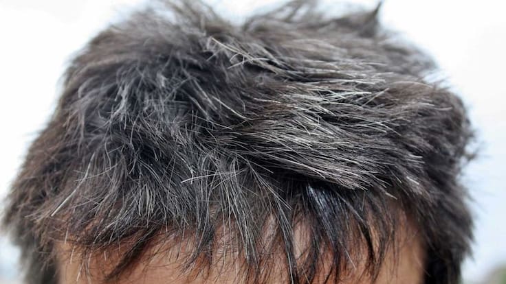 Tratamiento experimental para cáncer devuelve color negro o marrón al cabello canoso de pacientes