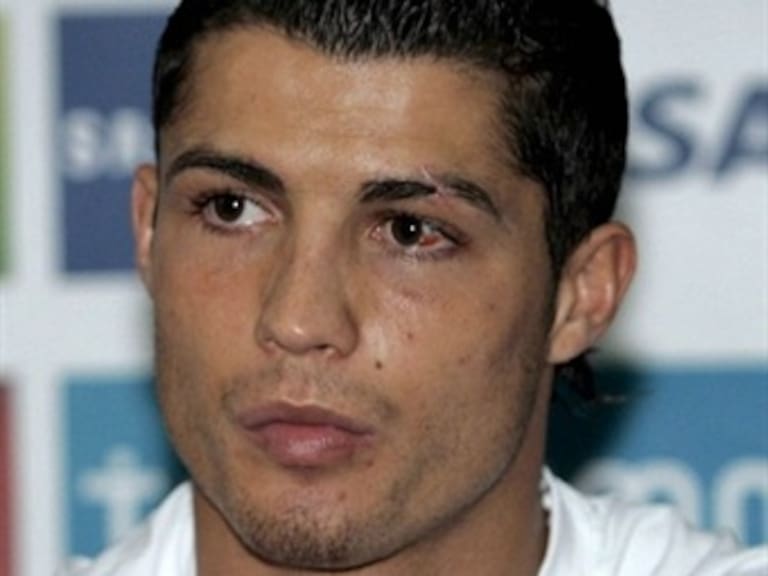 Asegura Cristiano Ronaldo que se siente mejor tras herida en el ojo