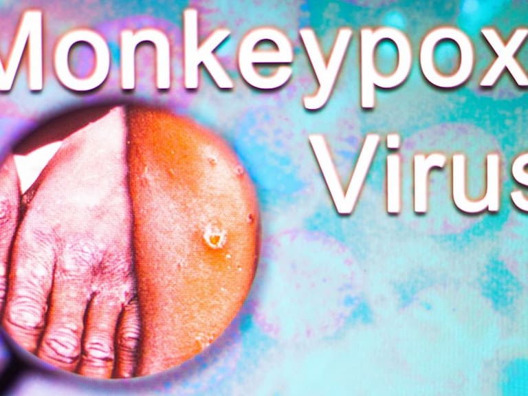 Suman tres muertes por viruela del mono fuera de África