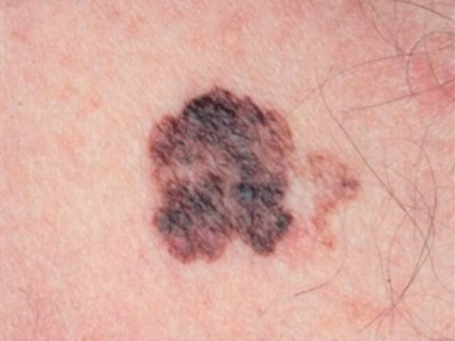 Señalan que melanoma es el cáncer de piel más agresivo