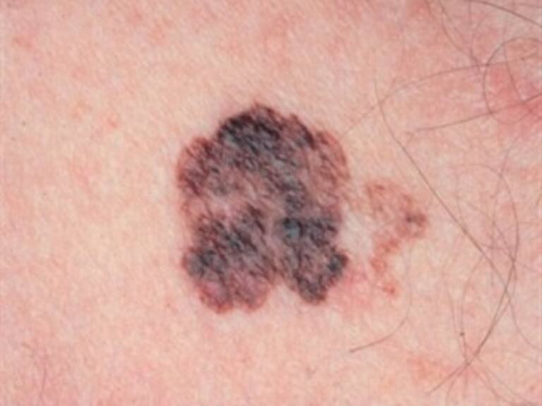 Señalan que melanoma es el cáncer de piel más agresivo