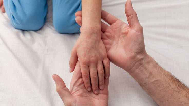 ¡No es solo un sarpullido! Academia de Pediatría advierte riesgos mortales del sarampión