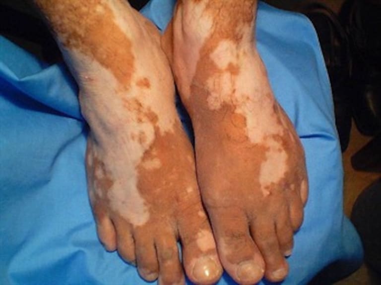 ¿Qué es el vitiligo?