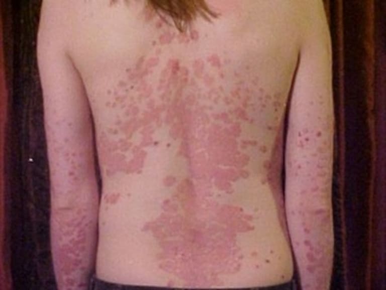 ¿Qué es la Psiorasis?