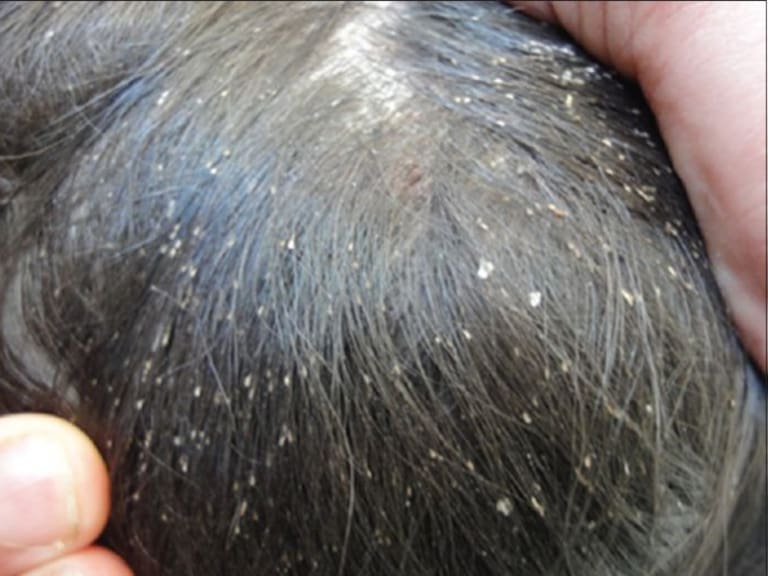 SSJ emite medidas de prevención contra piojos