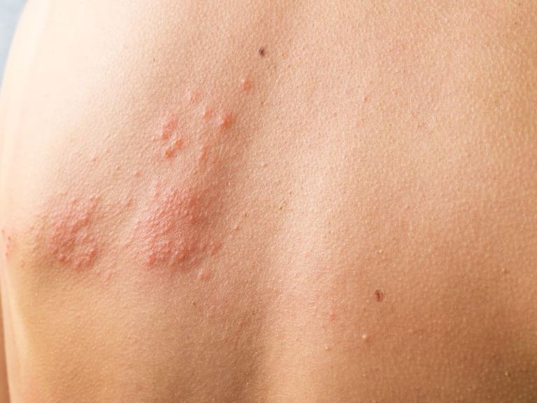 La mayoría de las personas contraen herpes zóster a partir de los 50 años