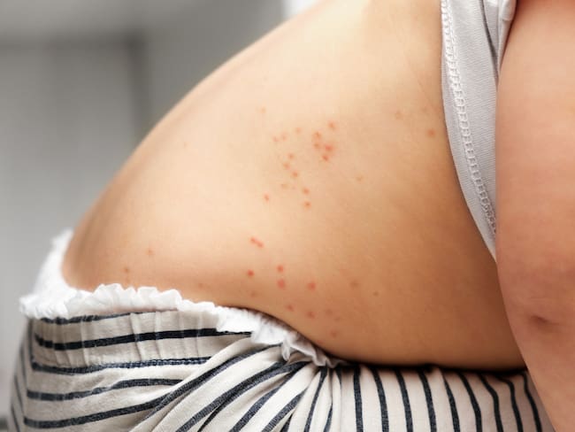 Lanza Secretaría de Salud aviso epidemiológico de sarampión en México