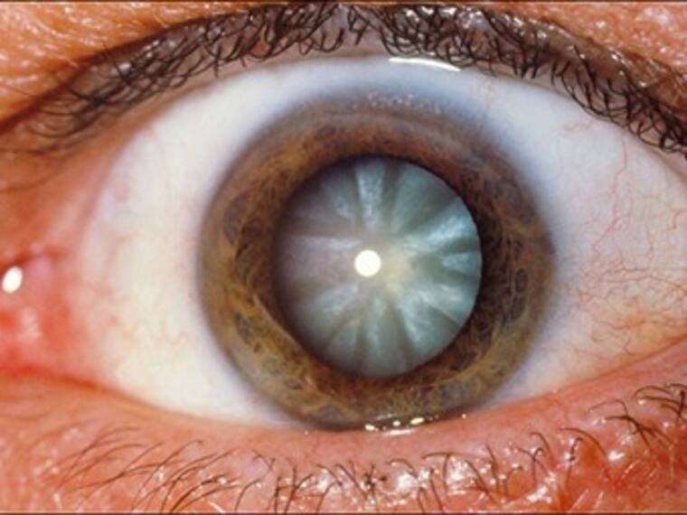 Todo sobre las cataratas