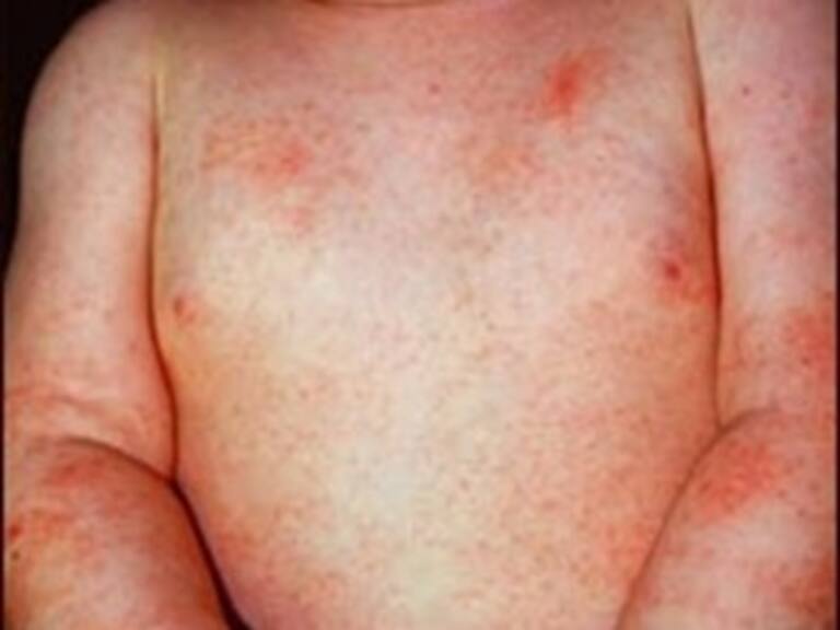 Afectan dermatitis atópica y urticaria a niños en época invernal