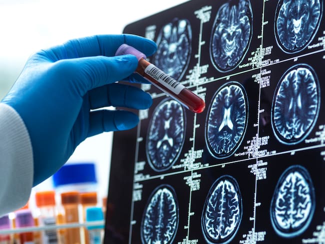 Un análisis de sangre promete detectar el riesgo de Alzheimer hasta una década antes de los síntomas