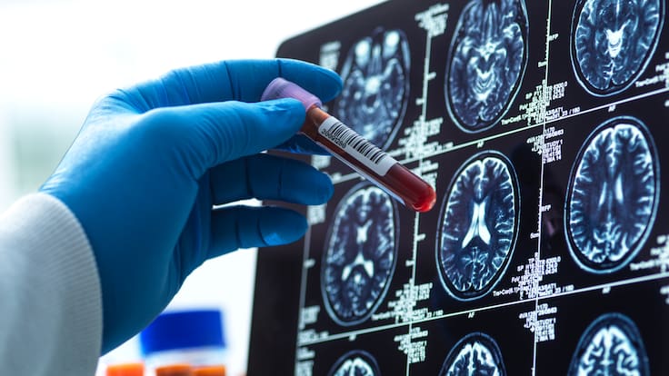 Un análisis de sangre promete detectar el riesgo de Alzheimer hasta una década antes de los síntomas