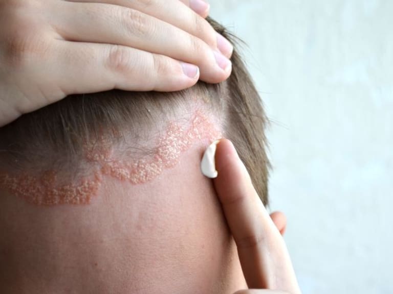 Dermatitis atópica, un mal más común de lo que parece