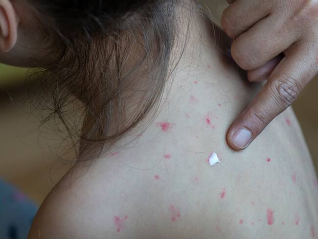 Ya existe transmisión de sarampión en México, deben realizar campañas de vacunación: Infectólogo