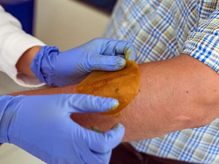 Científicos de la UNAM crean parche para regenerar piel de diabéticos