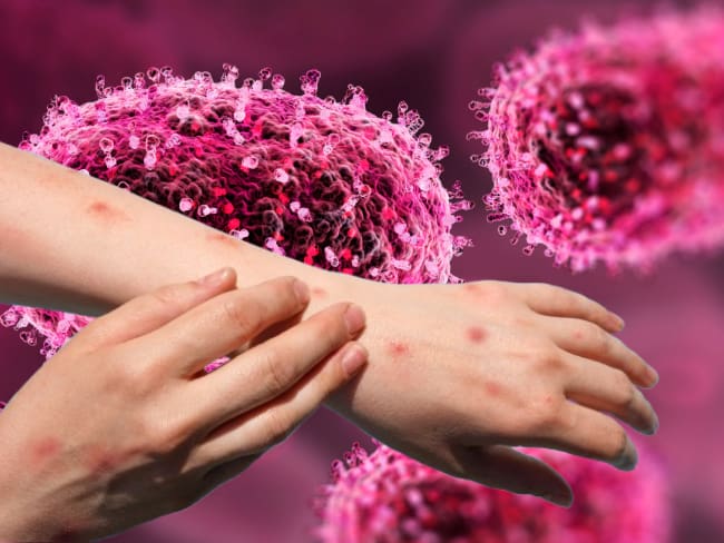 Repunte de viruela símica en México: CDMX concentra casi el 70% de los casos en 2026