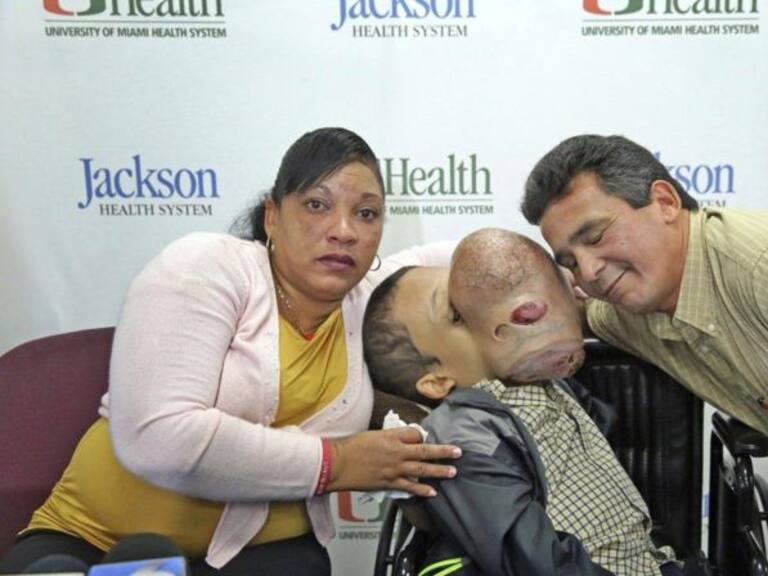 Fallece niño con tumor de 4 Kg en el rostro