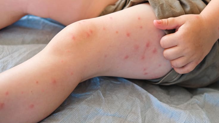 Sarampión México: CDMX registra tercera muerte y suman 37 fallecimientos