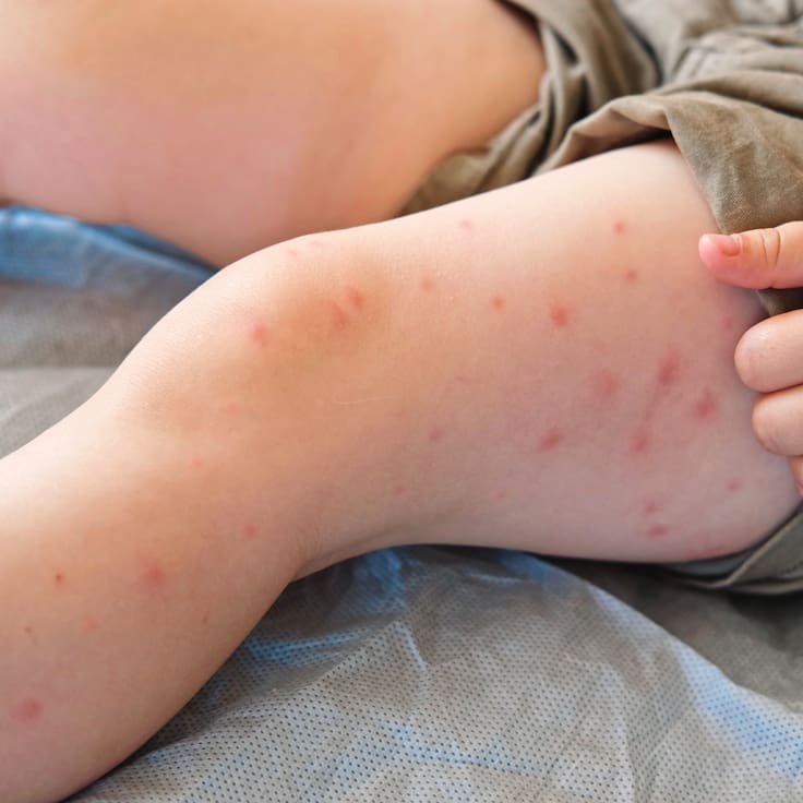 Sarampión México: CDMX registra tercera muerte y suman 37 fallecimientos