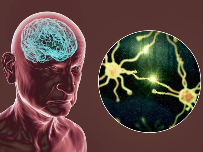 ¿Qué es la demencia frontotemporal?