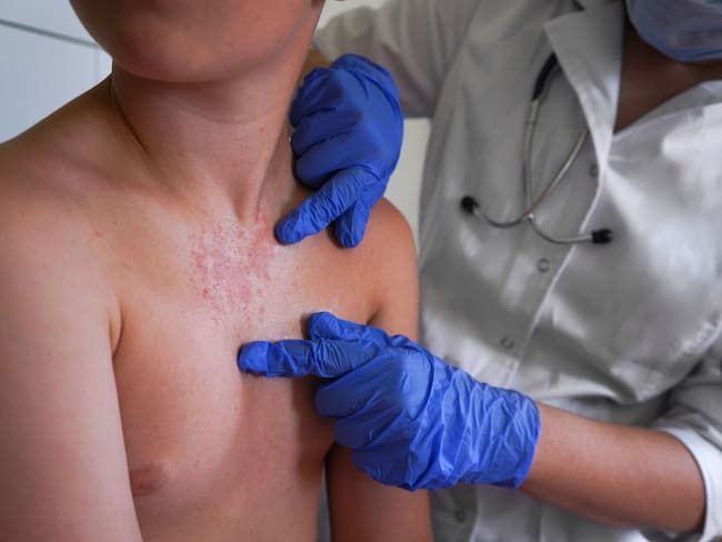 Sarampión en México: contagios superan los 16 mil en todo el país