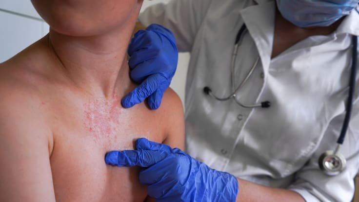 Sarampión en México: contagios superan los 16 mil en todo el país