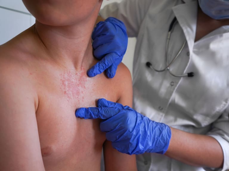 La distribución de sarampión por entidad muestra una concentración importante en Jalisco, que acumula 6 mil 214 casos, seguido de Chihuahua con 4 mil 575.