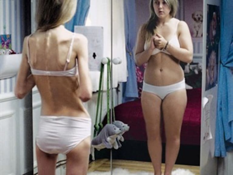 Diez de cada100 mujeres padecen anorexia en México
