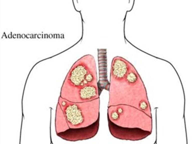 Consideran confiable broncoscopía para diagnosticar cáncer pulmonar