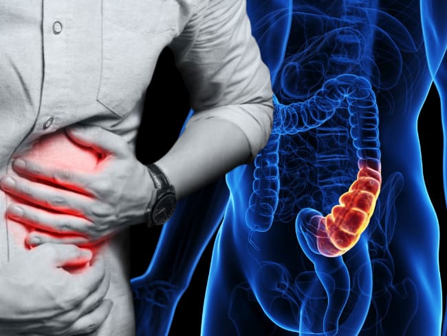 El cáncer colorrectal se convierte en la principal causa de muerte en adultos jóvenes menores de 50 años