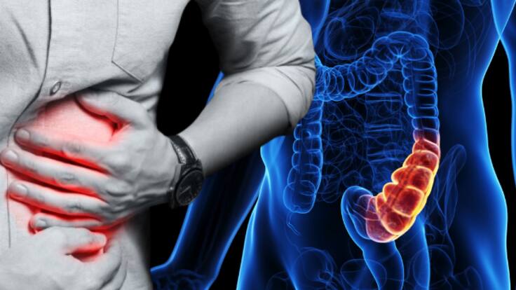 El cáncer colorrectal se convierte en la principal causa de muerte en adultos jóvenes menores de 50 años