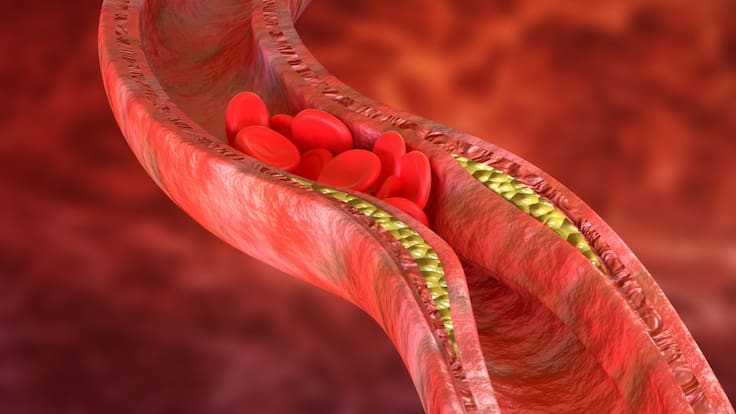 Lo que debes saber sobre los triglicéridos y el colesterol