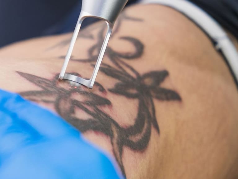Sesiones que te ayudan a eliminar el tatuaje que ya no te gusta