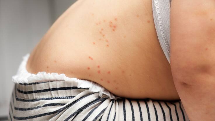 Responsabilizan a Sheinbaum por alerta de sarampión en México