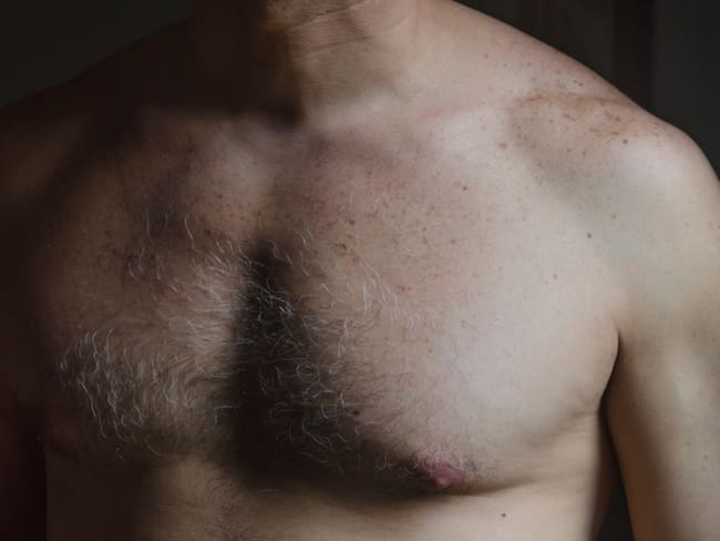 Los hombres también pueden padecer cáncer de mama: ¿Cómo detectarlo?