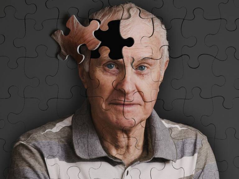 El Alzheimer provoca que un gran número de neuronas en el cerebro mueran