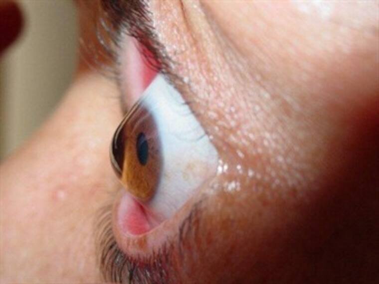 ¿Qué rayos es el Queratocono?